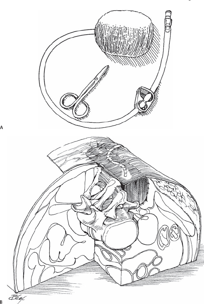 Kci Wound Vac Form Printable